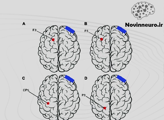 درمان با TDCS در مشهد