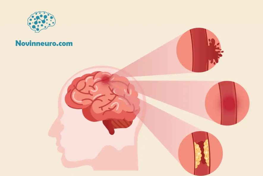 سکته مغزی